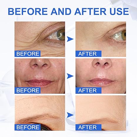 💙Last Day Promotion 70% OFF - Tiworld™ Botox Stock Solution