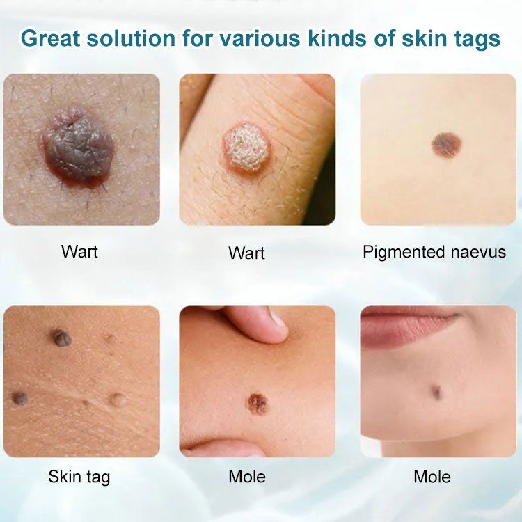 （🔥LAST DAY SALE-80% OFF) SEAGRIL™ Concentrated potent skin tag removal cream